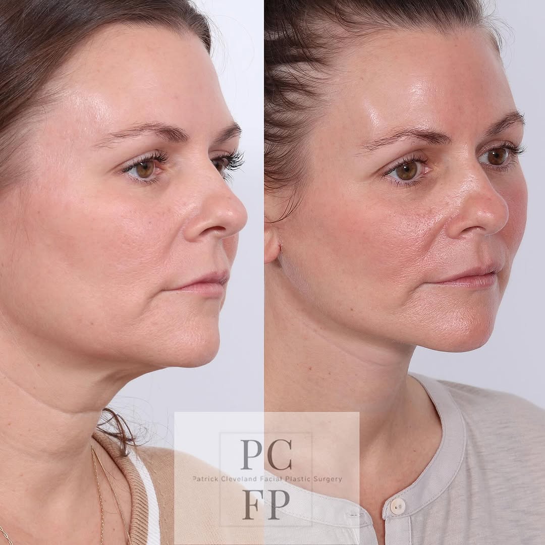 Instagram post by Dr. Patrick Cleveland: ✨Neck lift results that speak for themselves—at any age.✨ While many think of a neck lift as a procedure for later in life, the truth is: ge…