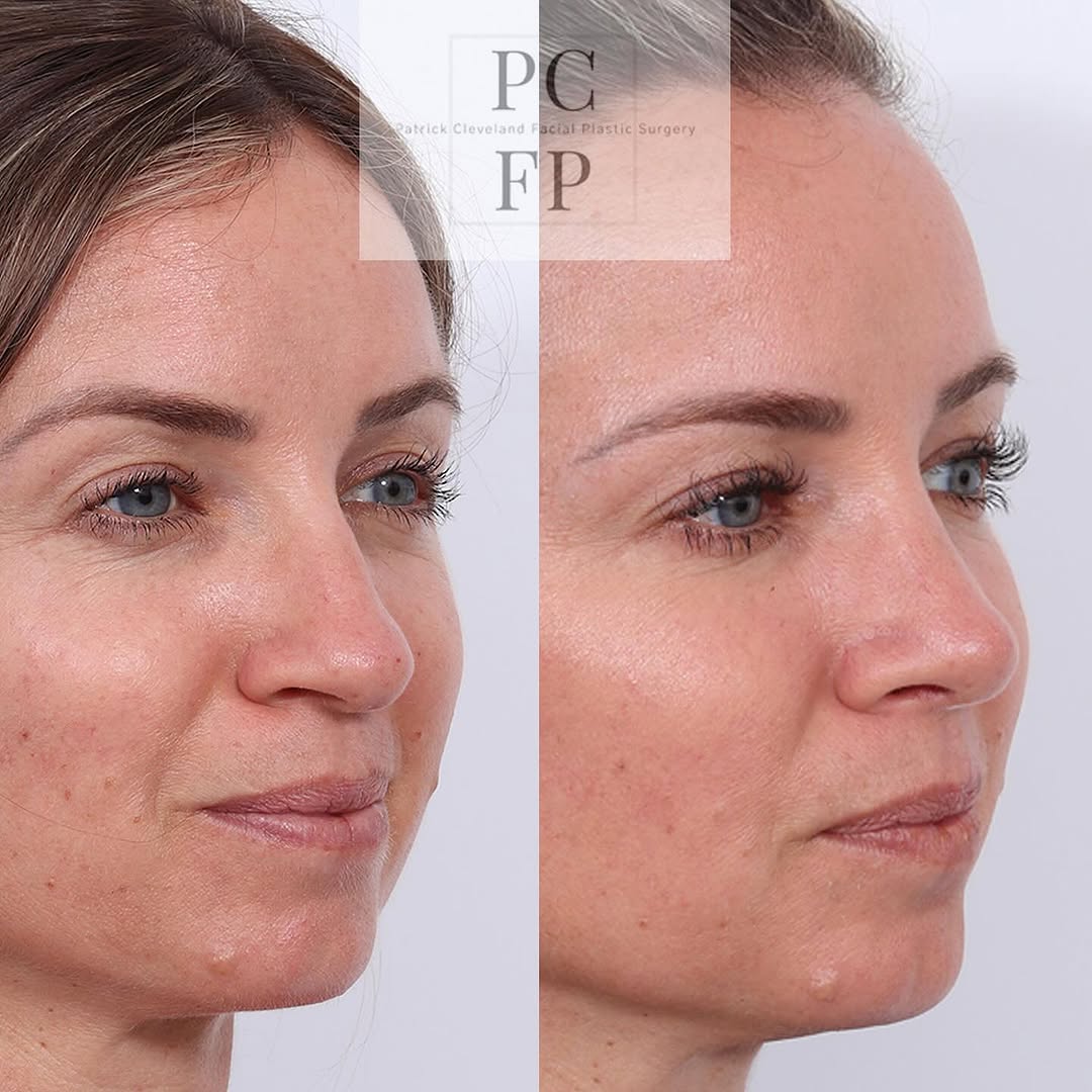 Instagram post by Dr. Patrick Cleveland: ✨Refined, not redefined.✨ This beautiful patient underwent a rhinoplasty to smooth a dorsal hump and refine a droopy tip—resulting in elegan…