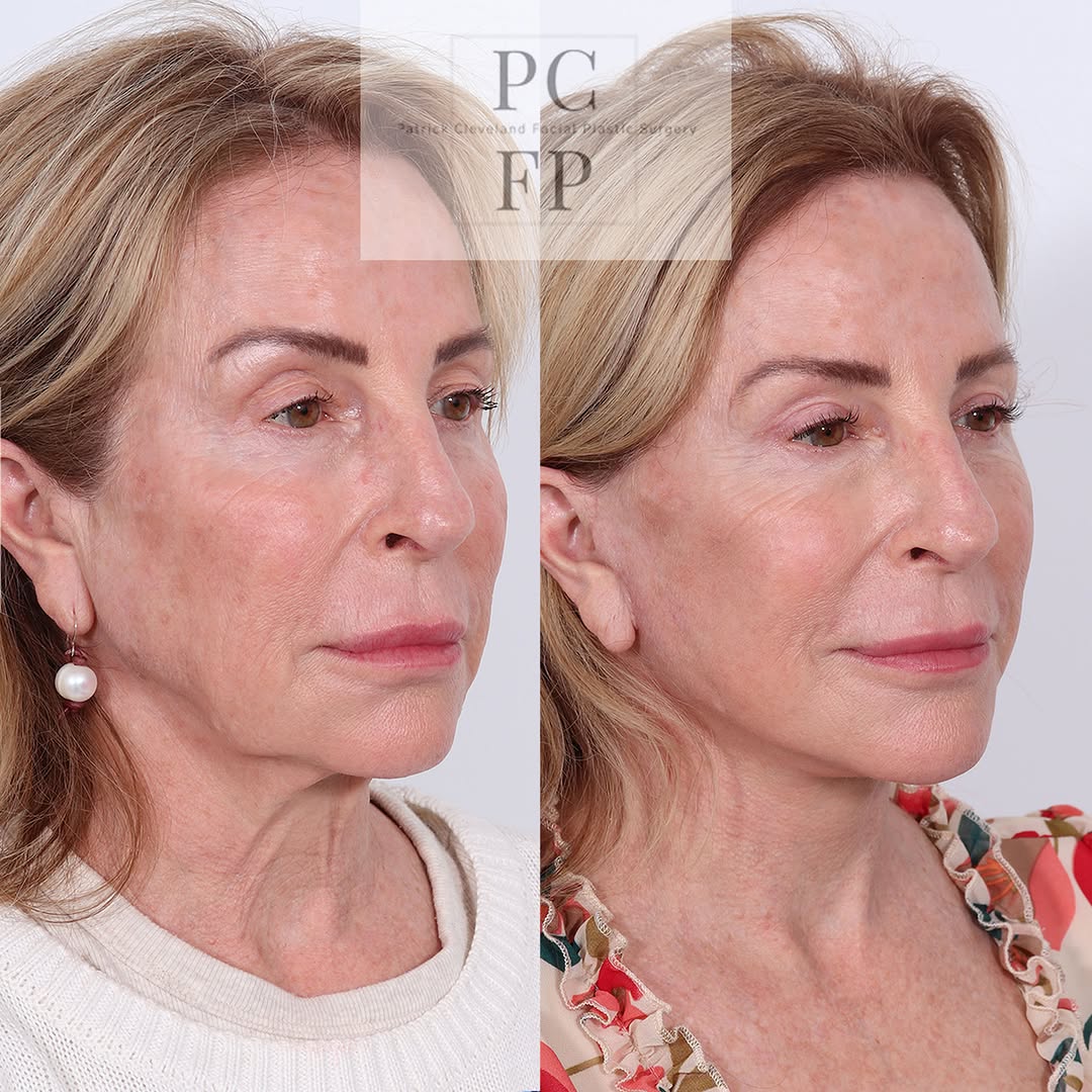 Instagram post by Dr. Patrick Cleveland: The goal of a facelift isn’t to change who you are—it’s to smooth, restore, and bring back the definition that time can soften. Natural-look…