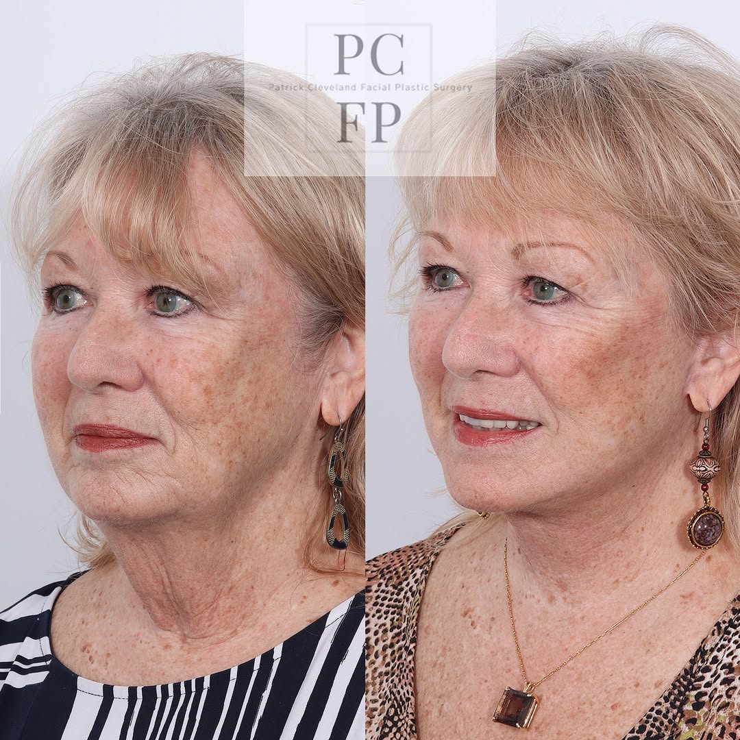 Instagram post by Dr. Patrick Cleveland: ✨ Subtle changes, beautiful results. Combining a facelift with liposuction can help create a more balanced, refreshed appearance while prese…