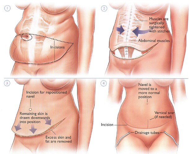 Instagram post by Dr. Patrick J. Budny: A tummy tuck, also known as an abdominoplasty, is a surgical procedure that removes excess fat and skin from the abdomen to create a smoothe…
