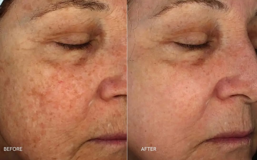 Instagram post by Dr. Patrick Joseph Greaney Jr: Summer may be coming to an end, but it’s the perfect time to refresh your skin ✨ This HALO® Laser before & after shows the power of improvin…