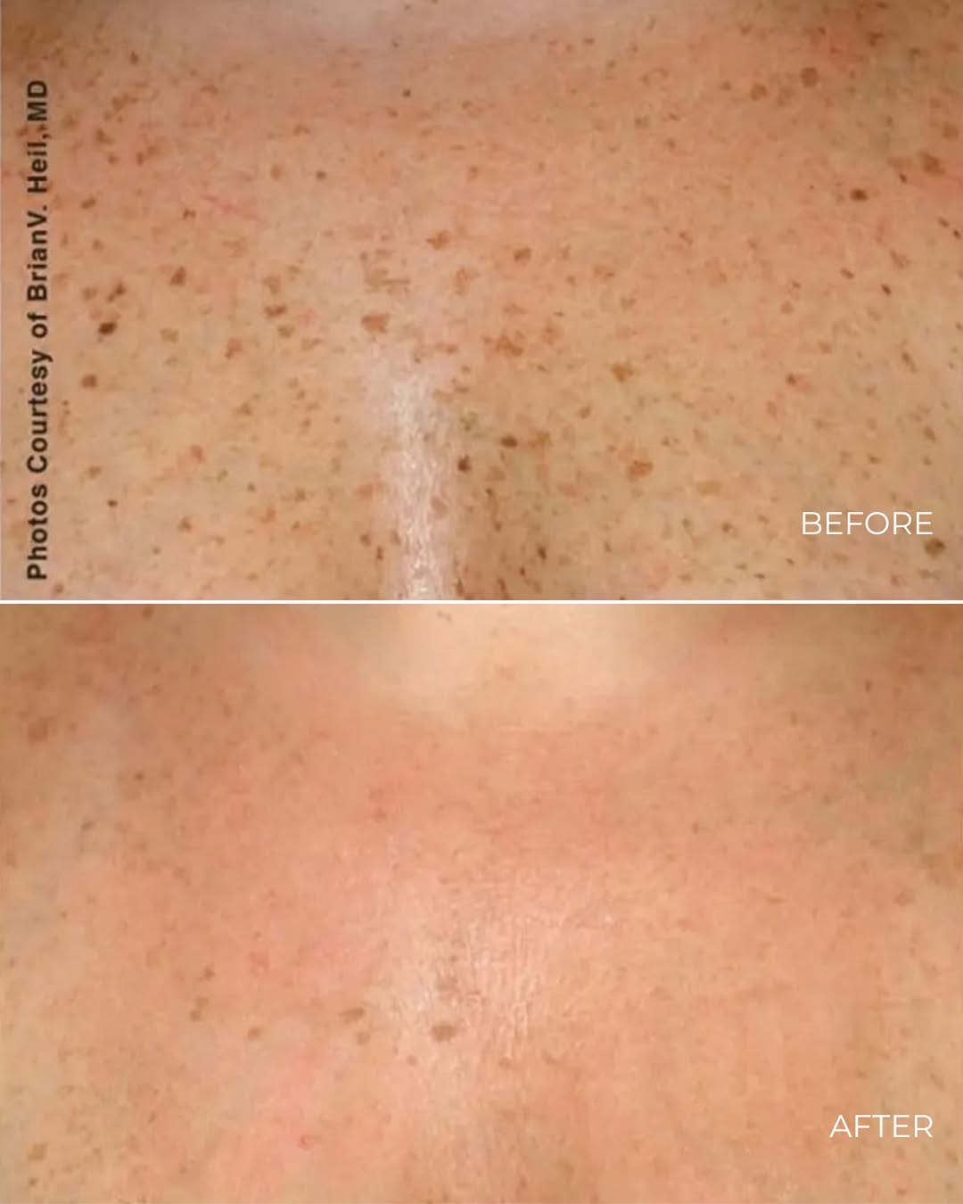 Instagram post by Dr. Patrick Joseph Greaney Jr: Sun damage doesn’t stop at your face ☀️ BBL Laser is a great way to target visible sun damage, dark spots and uneven tone, but don’t forget …