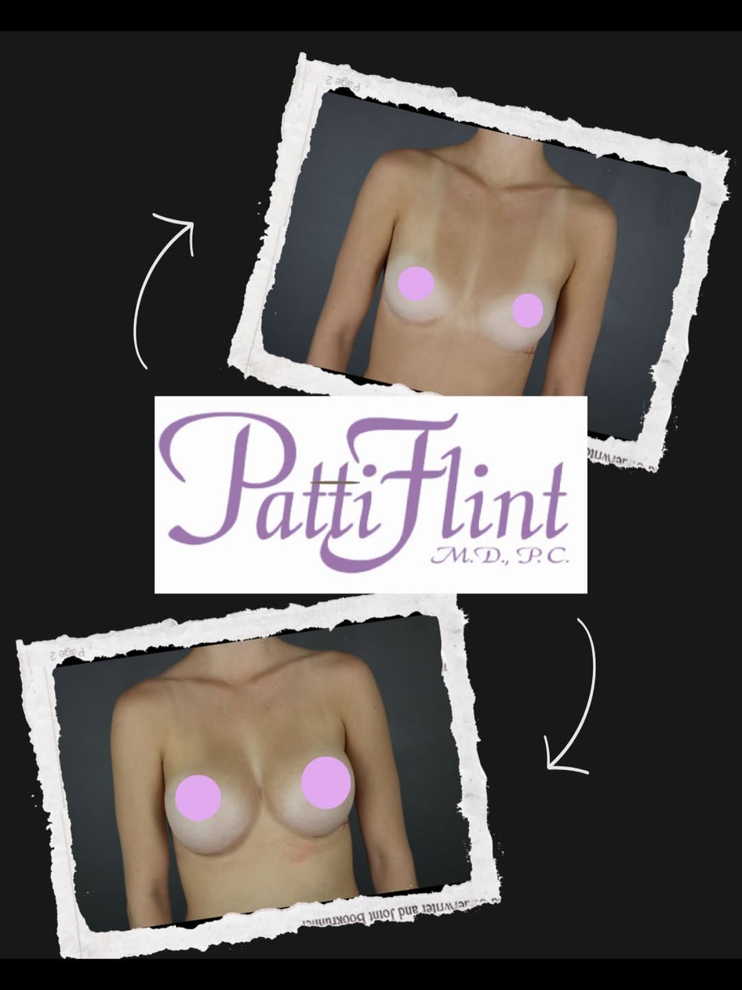 Instagram post by Dr. Patti A. Flint: This lovely young patient was self-conscious about her breast asymmetry. By using two different profiles and different volumes of smooth sil…