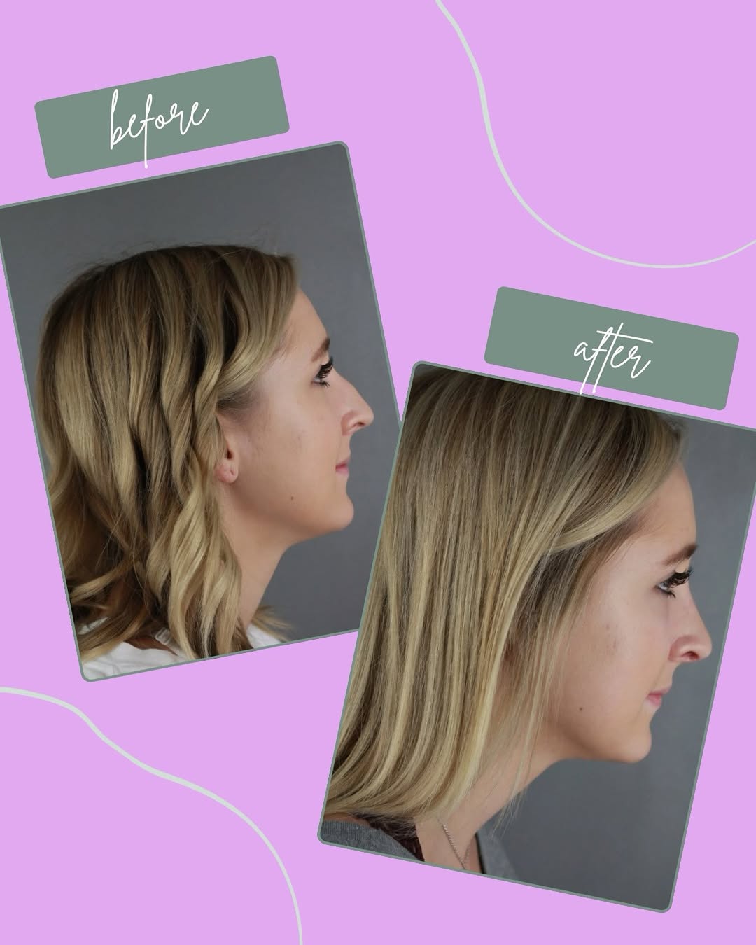 Instagram post by Dr. Patti A. Flint: This beautiful young patient was self-conscious about her profile. One ninety minute surgery later she obtained her desired outcome. She’s s…
