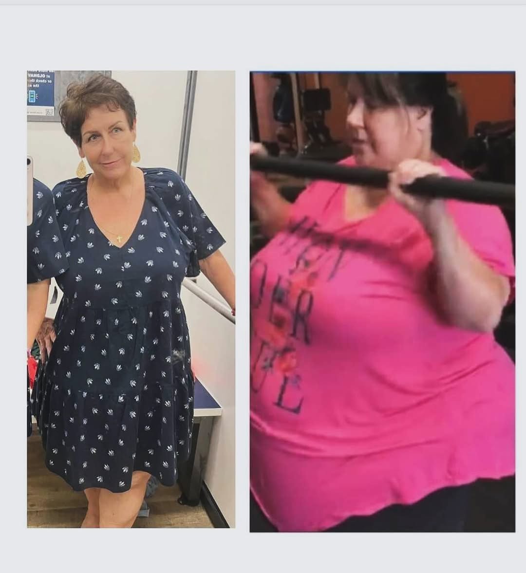 Instagram post by Dr. Paul B. Wizman: My amazing patient lost 240lb! #drwizman #gastricsleeve #weightlosssurgery #bariatricsurgery #bariatricpatient #bariatricsurgeon #weightloss…