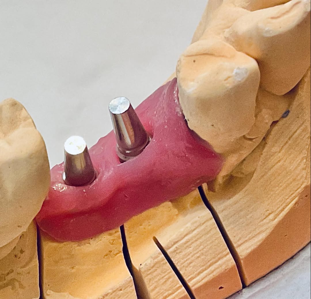 Instagram post by Dr. Paul D. Kantor, DDS: Dental implant abutment analogs. #dentalimplants, #dentalimplant #dentalimplantology