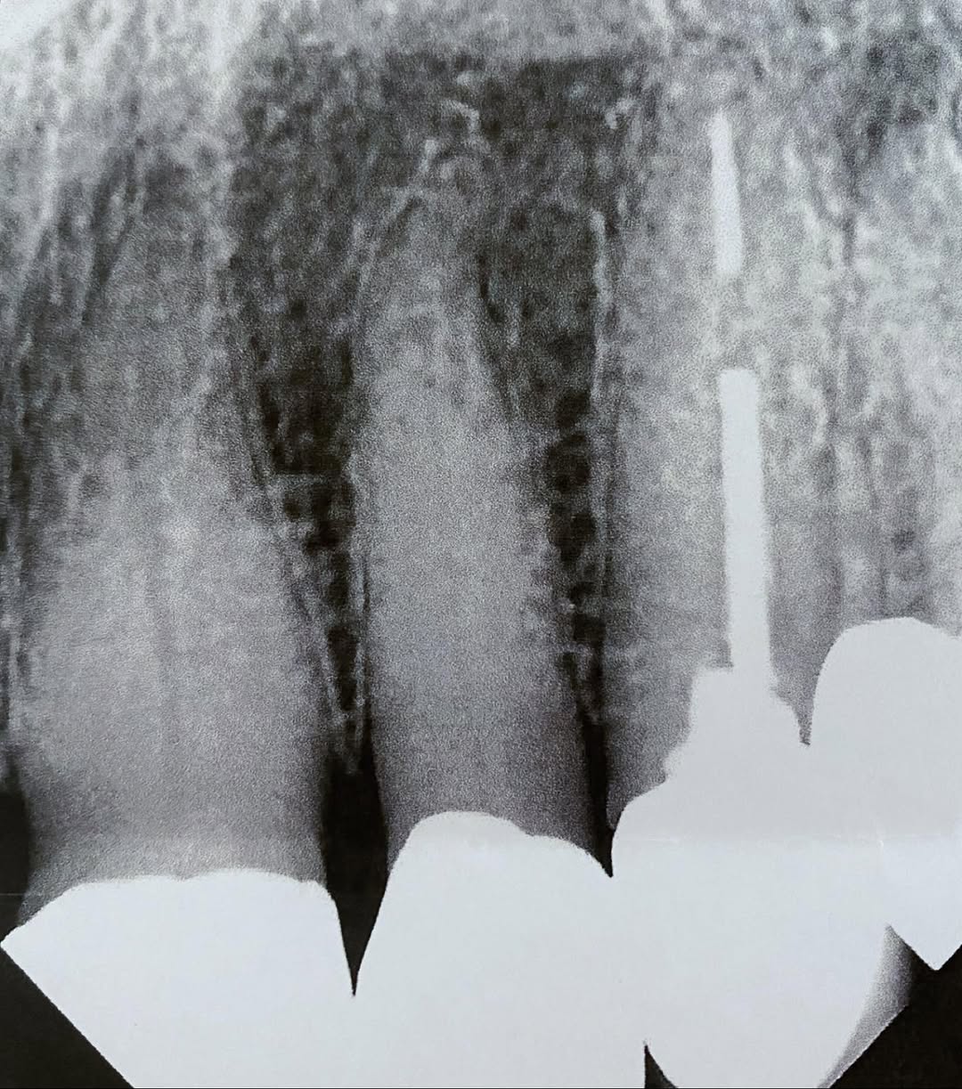 Instagram post by Dr. Paul D. Kantor, DDS: Endodontic consult. #endodontist, #endodontic, #endodontictreatment