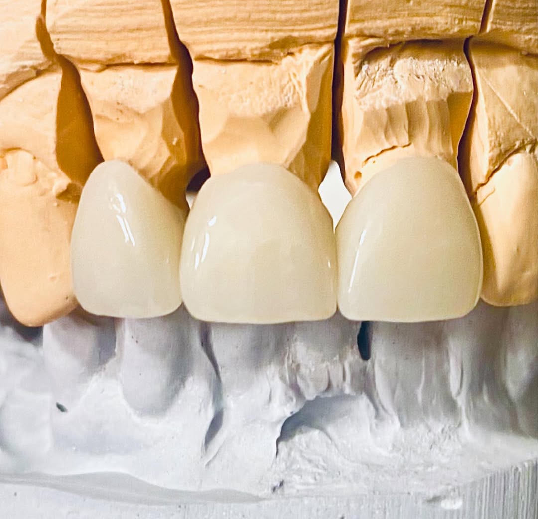 Instagram post by Dr. Paul D. Kantor, DDS: Anterior zirconia crowns. #zirconiacrown, #zirconiacrowns, #dentalcrowns, #dentalcrown