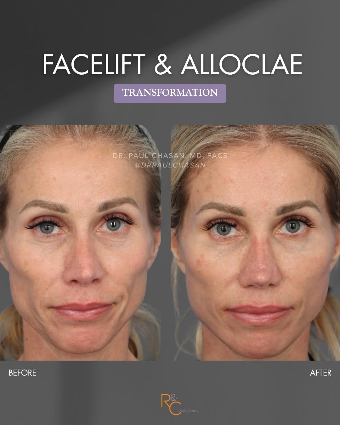 Instagram post by Dr. Paul E. Chasan: Restoring facial volume while preserving what makes her look like her. ✨ This patient underwent a facelift and received AlloClae to restore …