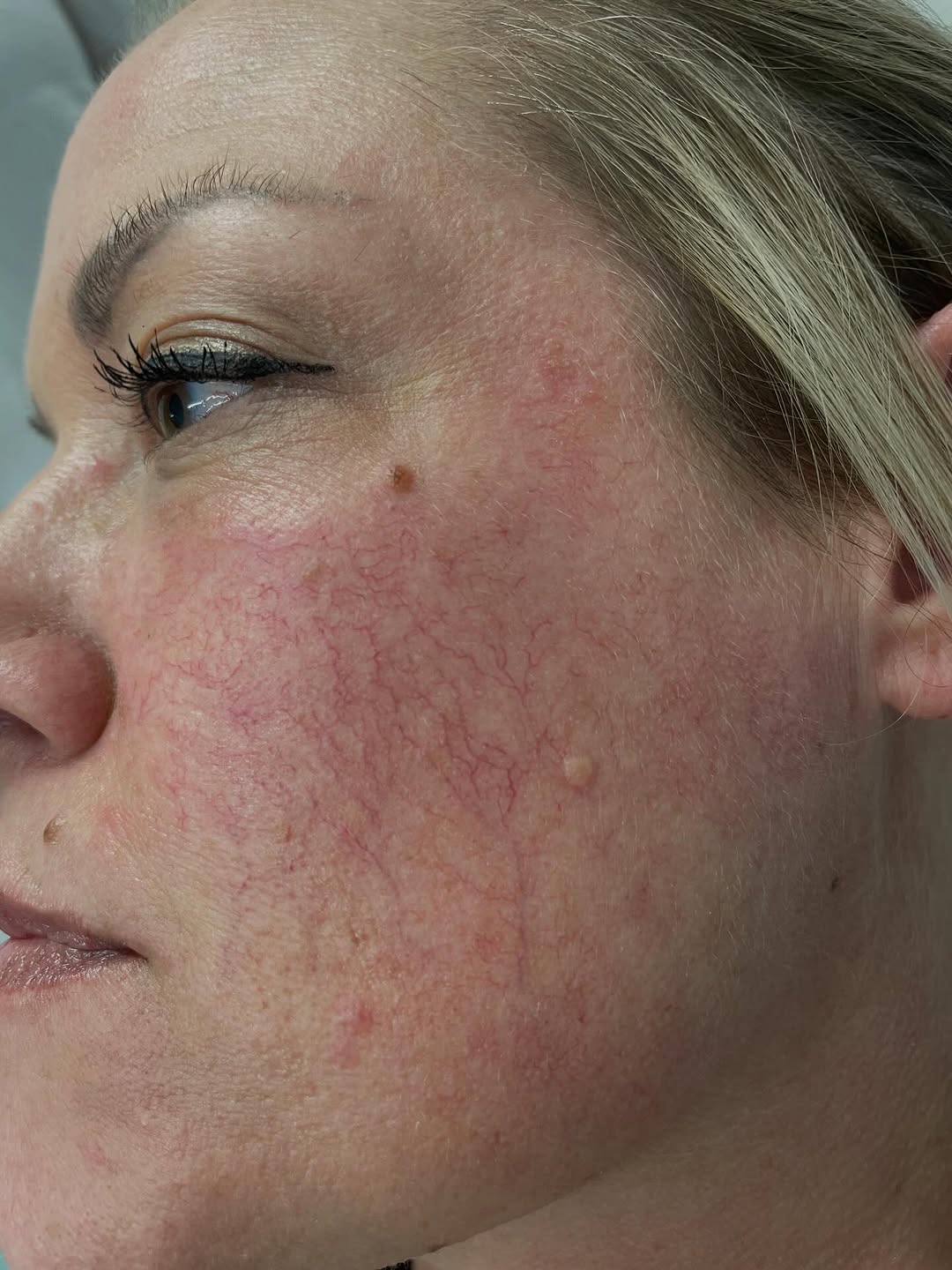 Instagram post by Dr. Paul Fischer: Broken capillaries don’t have to be permanent ✨ Our laser treatments target visible vessels and redness to leave your skin looking clearer, …