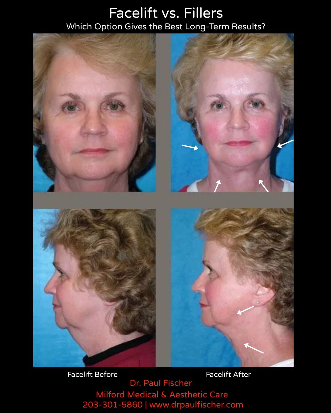 Instagram post by Dr. Paul Fischer: Facelift vs. Fillers: Which Gives Better Long-Term Results? The answer isn't based on your age—it's based on why your face has changed. Many…