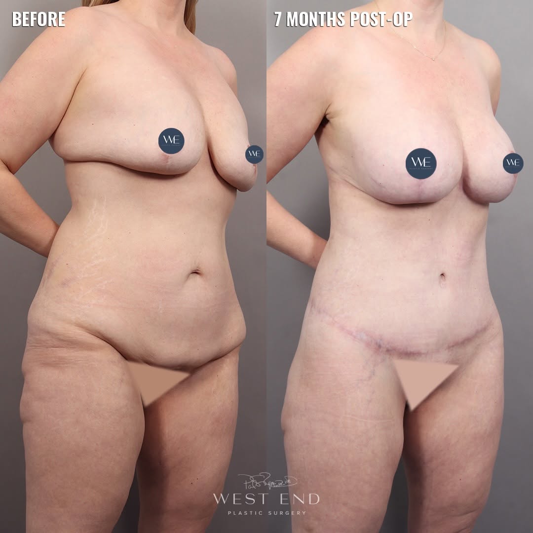 Instagram post by Dr. Paul G. Ruff IV: After two pregnancies and a significant weight loss of approximately 70 pounds, this patient came to Dr. Ruff seeking a comprehensive Mommy …