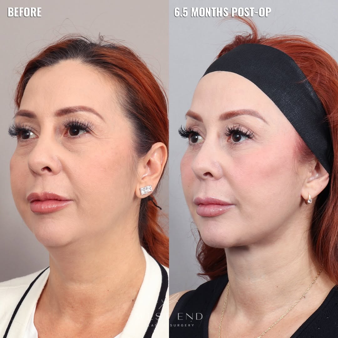 Instagram post by Dr. Paul G. Ruff IV: ✨ Comprehensive Facial Rejuvenation | 6.5 Months Post-Op At 50 years old, this patient wanted to address concerns about her jawline, neck, e…
