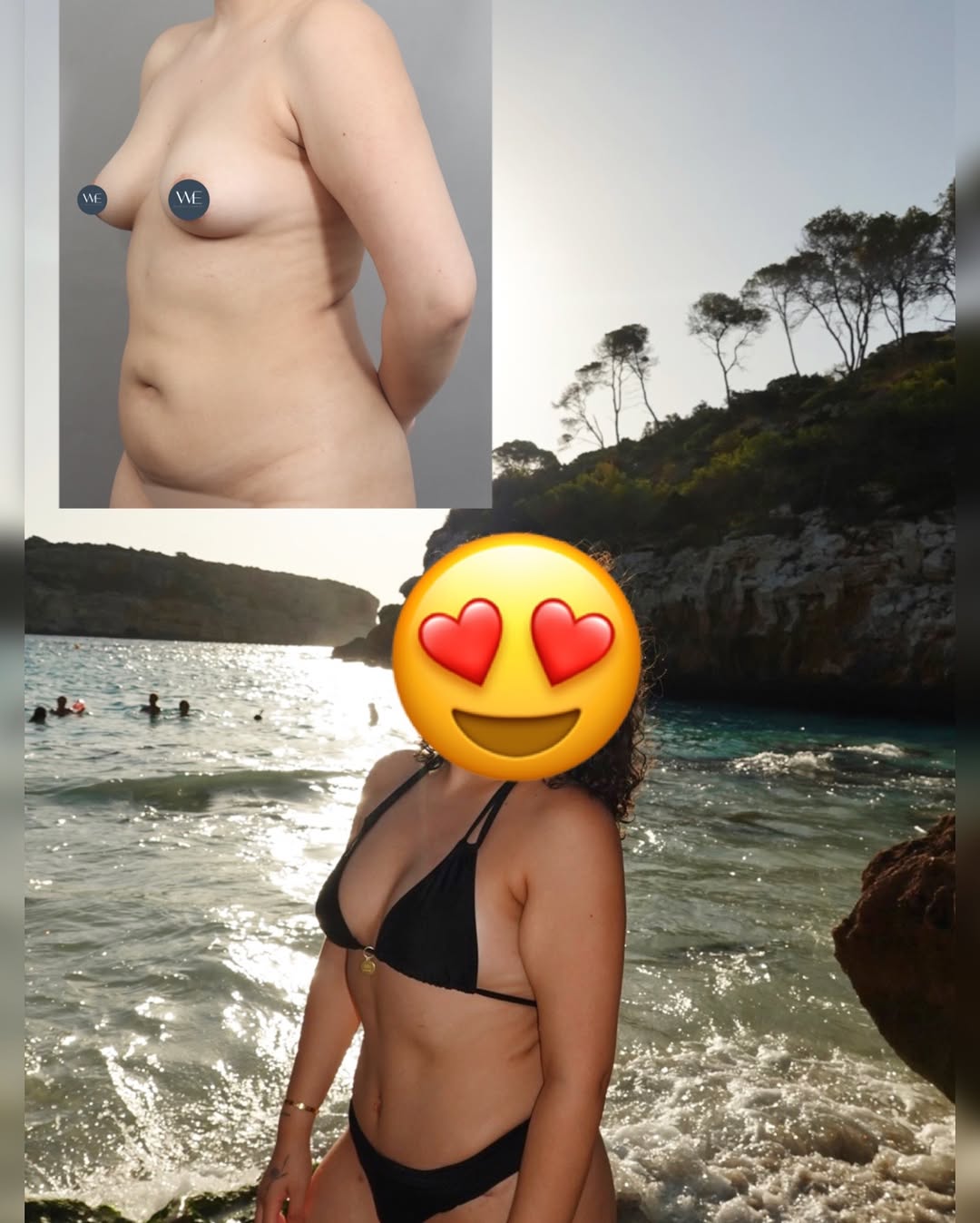 Instagram post by Dr. Paul G. Ruff IV: 6 Weeks Post-Op and Already Back to Living Life 🌊 This 24-year-old patient came to Dr. Anthony Nye looking for a flatter, more defined abdo…