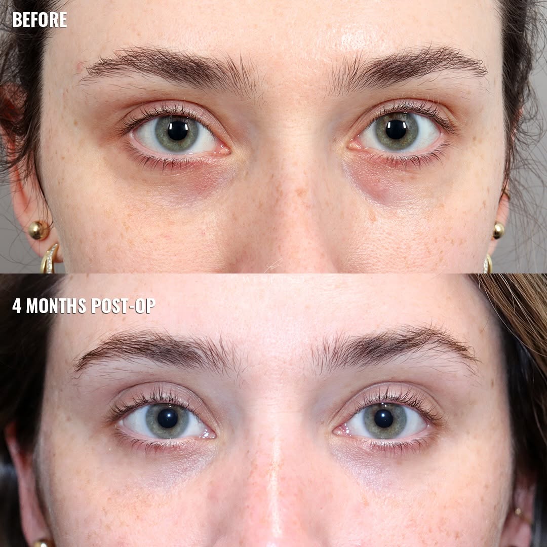 Instagram post by Dr. Paul G. Ruff IV: Lower Blepharoplasty | 4 Months Post-Op 👀 This beautiful patient came to us bothered by under-eye darkness, puffiness, and the overall cont…