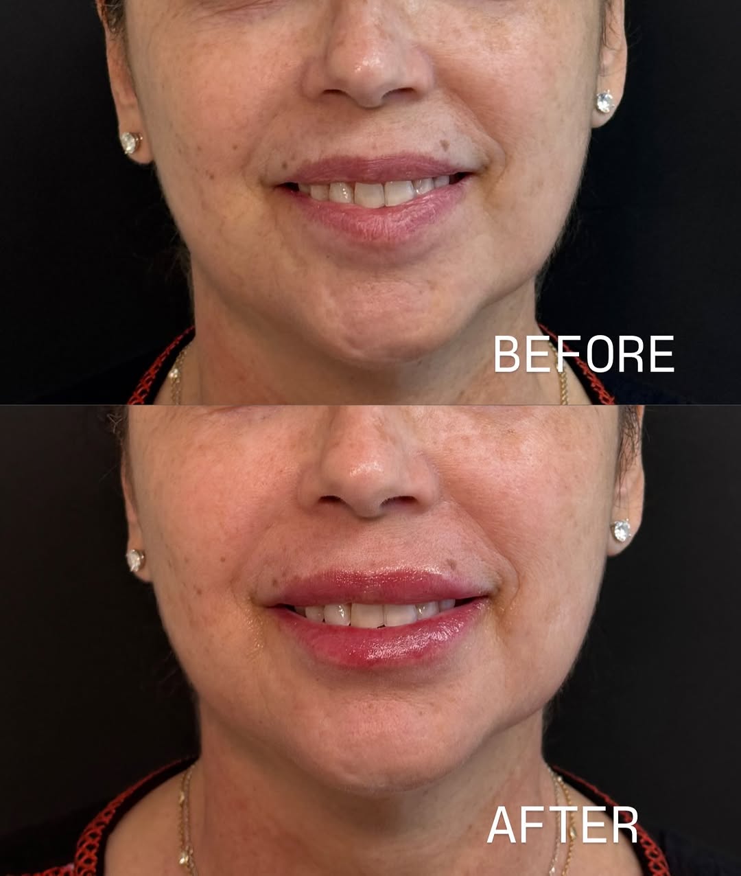 Instagram post by Dr. Paul Gorman: A subtle lip filler result designed to help with lip symmetry, smooth the appearance of wrinkles, and enhance hydration while maintaining a …