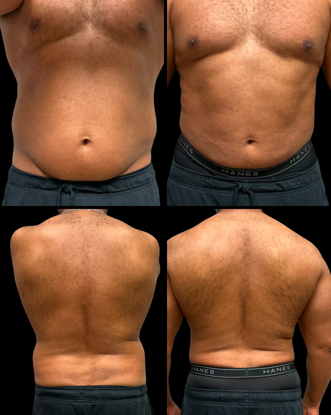 Instagram post by Dr. Paul J. Leahy: Plastic surgery isn’t only for the ladies! This patient was already very active, but had stubborn belly fat. He underwent liposuction to the…