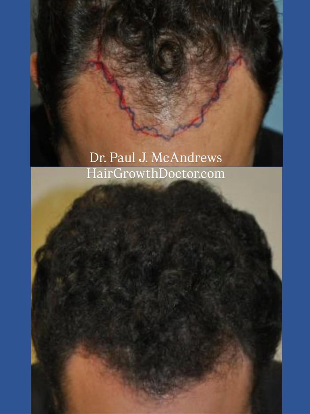 Instagram post by Dr. Paul J. McAndrews: This “Before & After” successful hair transplant with only 1,600 grafts is an example of Dr. Paul J. McAndrews guiding philosophy: Follow na…