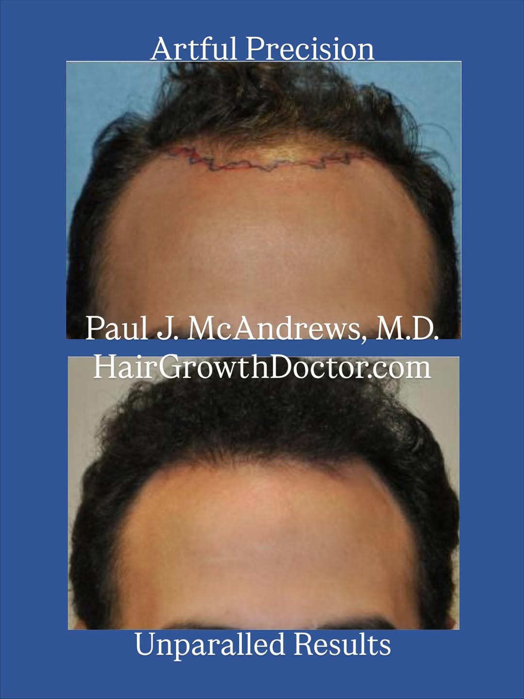 Instagram post by Dr. Paul J. McAndrews: Bring your hair back to a fully natural and healthy look. Dr. Paul J. McAndrews is the hair restoration expert, not just because of his medi…