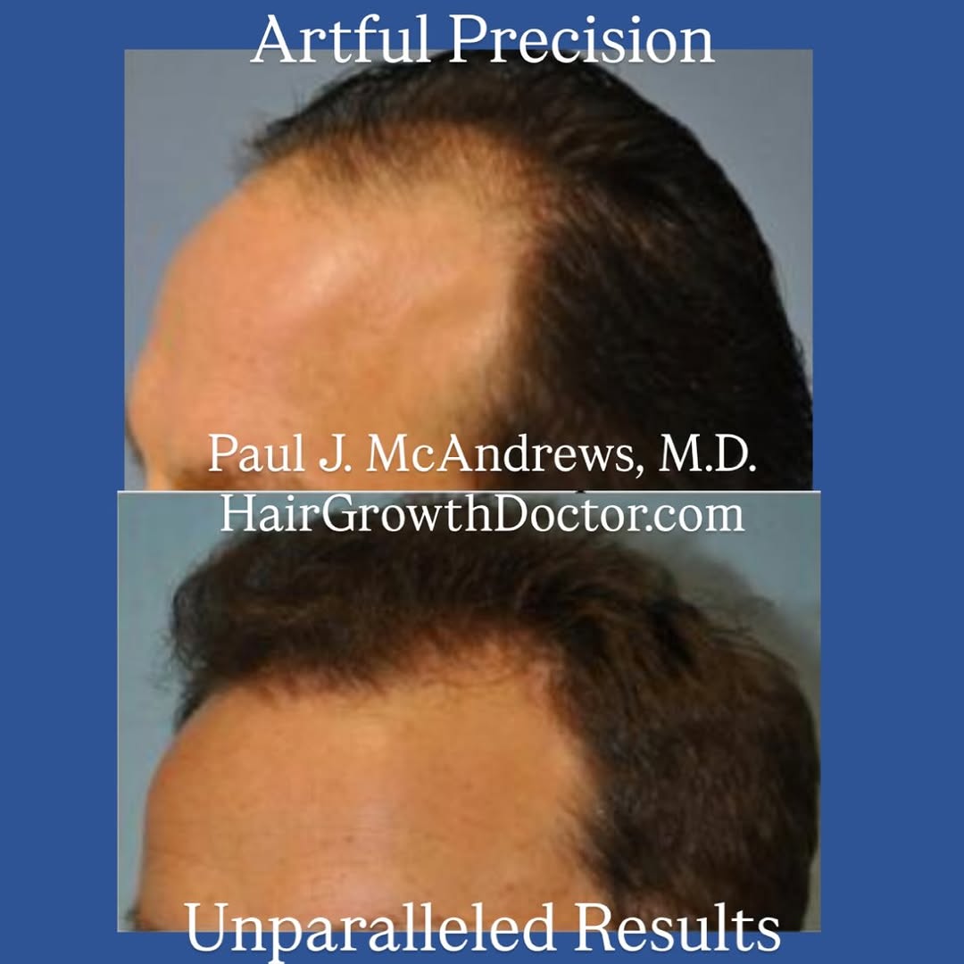 Instagram post by Dr. Paul J. McAndrews: The best hair transplant doesn’t look like one at all. Dr. McAndrews achieves natural-looking hair transplant results by following the examp…