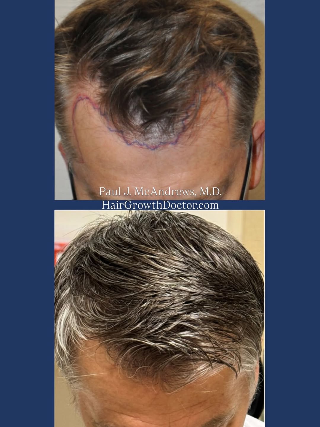 Instagram post by Dr. Paul J. McAndrews: The McAndrews Method achieves 4 goals vital to a successful hair transplant: ✅ A result that’s as natural as possible & virtually undetectab…