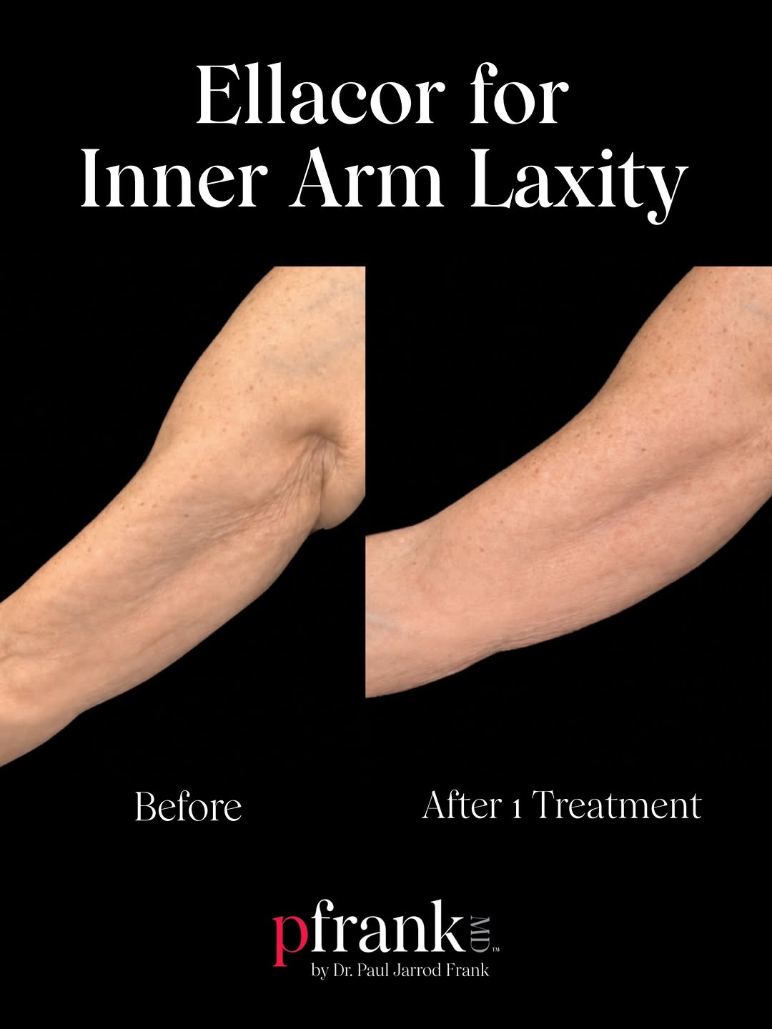 Instagram post by Dr. Paul Jarrod Frank: 𝐀𝐫𝐦 𝐑𝐞𝐣𝐮𝐯𝐞𝐧𝐚𝐭𝐢𝐨𝐧 𝐰𝐢𝐭𝐡 𝐄𝐥𝐥𝐚𝐜𝐨𝐫 𝐅𝐫𝐚𝐜𝐭𝐢𝐨𝐧𝐚𝐥 𝐌𝐢𝐜𝐫𝐨-𝐂𝐨𝐫𝐢𝐧𝐠 ✨ 𝐈𝐧𝐧𝐞𝐫 𝐚𝐫𝐦 𝐥𝐚𝐱𝐢𝐭𝐲 𝐚𝐧𝐝…