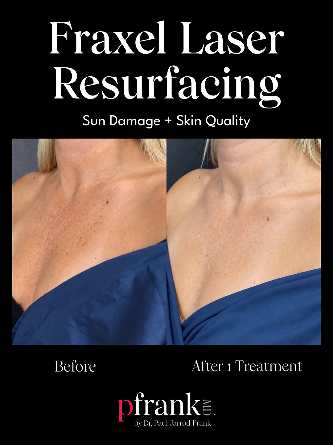 Instagram post by Dr. Paul Jarrod Frank: Sun-damaged skin is messy. Clean up your room before it gets too dirty. This patient is in her mid-30s, with years of accumulated sun exposu…