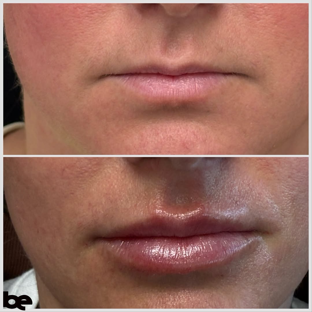 Instagram post by Dr. Paul L. Hester: Petite thin lips ➡️ crisp, structured & beautifully balanced. 💋✨ She started with naturally very thin lips and wanted more than just volume…