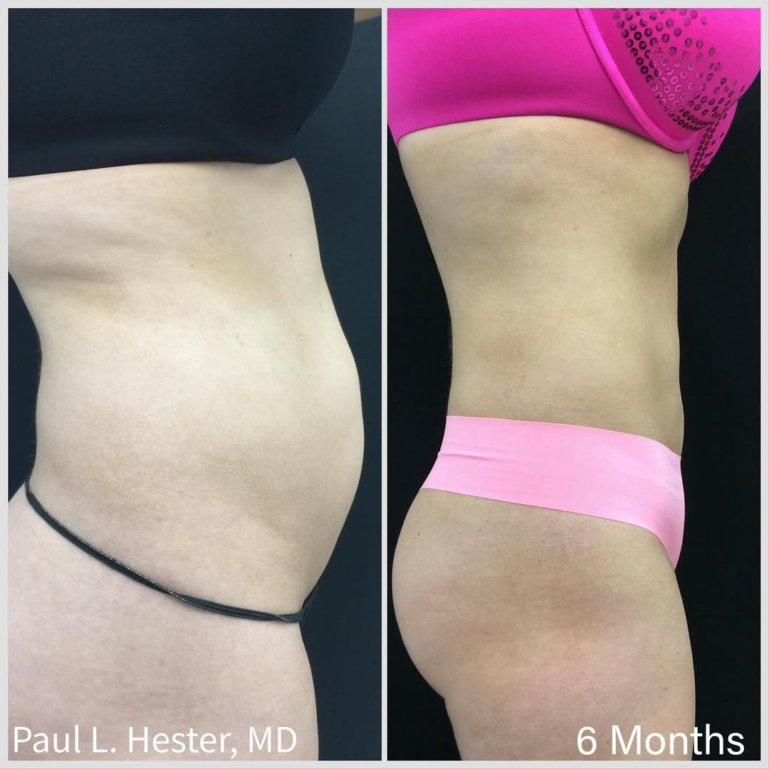 Instagram post by Dr. Paul L. Hester: Stubborn fat + loose skin is exactly where BodyTite can make sense. 🔥 Unlike treatments like CoolSculpting that primarily target fat, BodyT…