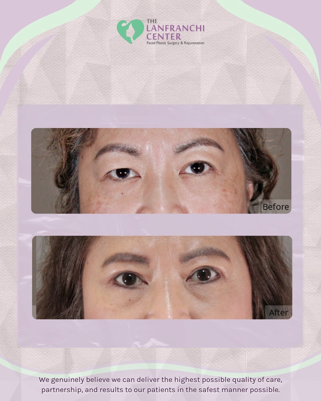 Instagram post by Dr. Paul Lanfranchi, DO, FAOCO: Heavy lids, be gone. 👀✨ Upper Blepharoplasty removes excess eyelid skin for a brighter, more awake look, naturally. Ready for your own refr…