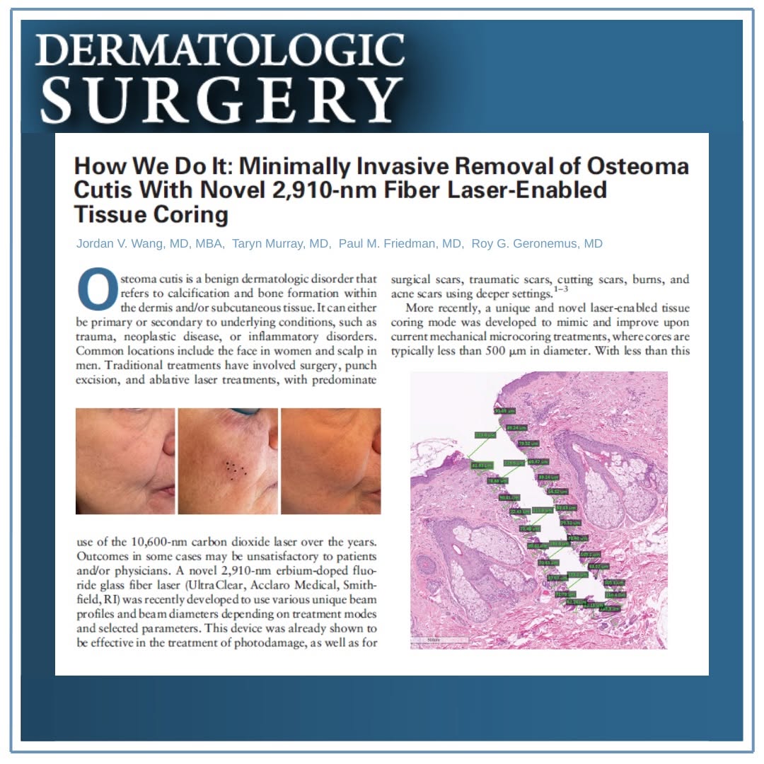 Instagram post by Dr. Paul M. Friedman: We are excited to share our recent publication in the peer-reviewed journal Dermatologic Surgery, “How We Do It: Minimally Invasive Removal …
