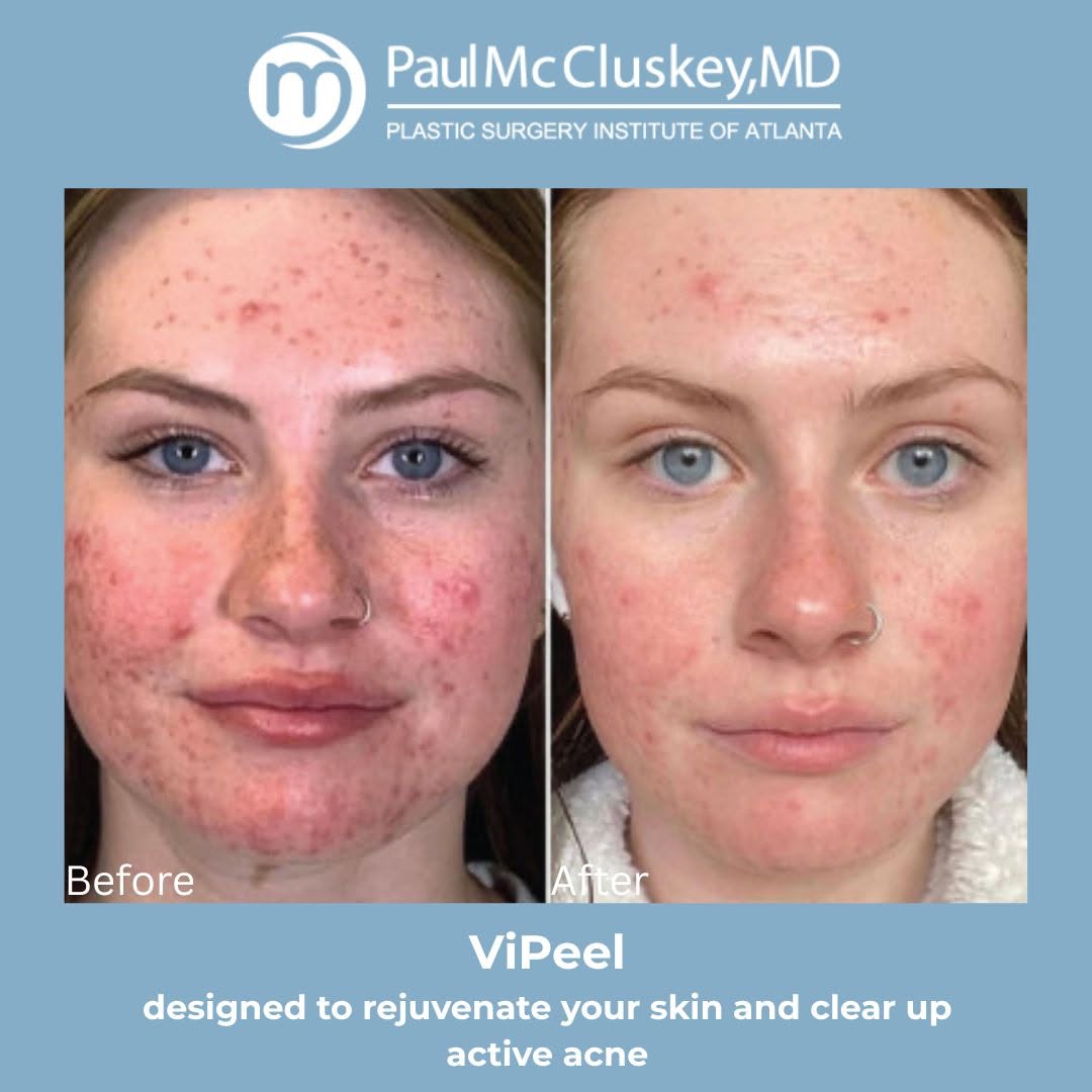 Instagram post by Dr. Paul McCluskey: Teen acne can be frustrating but the right treatment plan can make a real difference. ✨ ViPeels help clear clogged pores, reduce breakouts, …