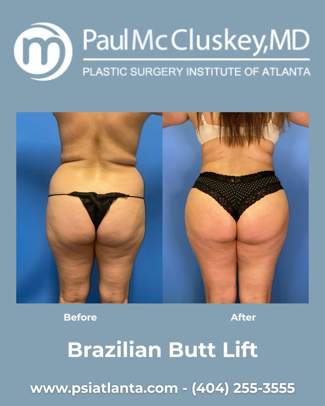 Instagram post by Dr. Paul McCluskey: Transformative results with a Brazilian Butt Lift at the Plastic Surgery Institute of Atlanta. Visit us to learn more about your options! (4…