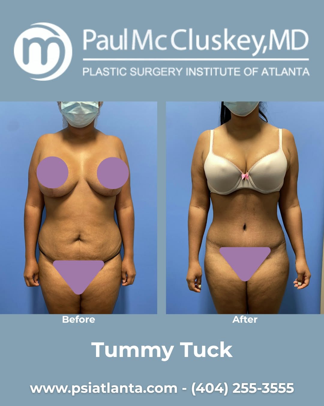 Instagram post by Dr. Paul McCluskey: A flatter, more sculpted tummy! ✨ This beautiful tummy tuck transformation removed excess skin and tightened the abdominal area for a smooth…
