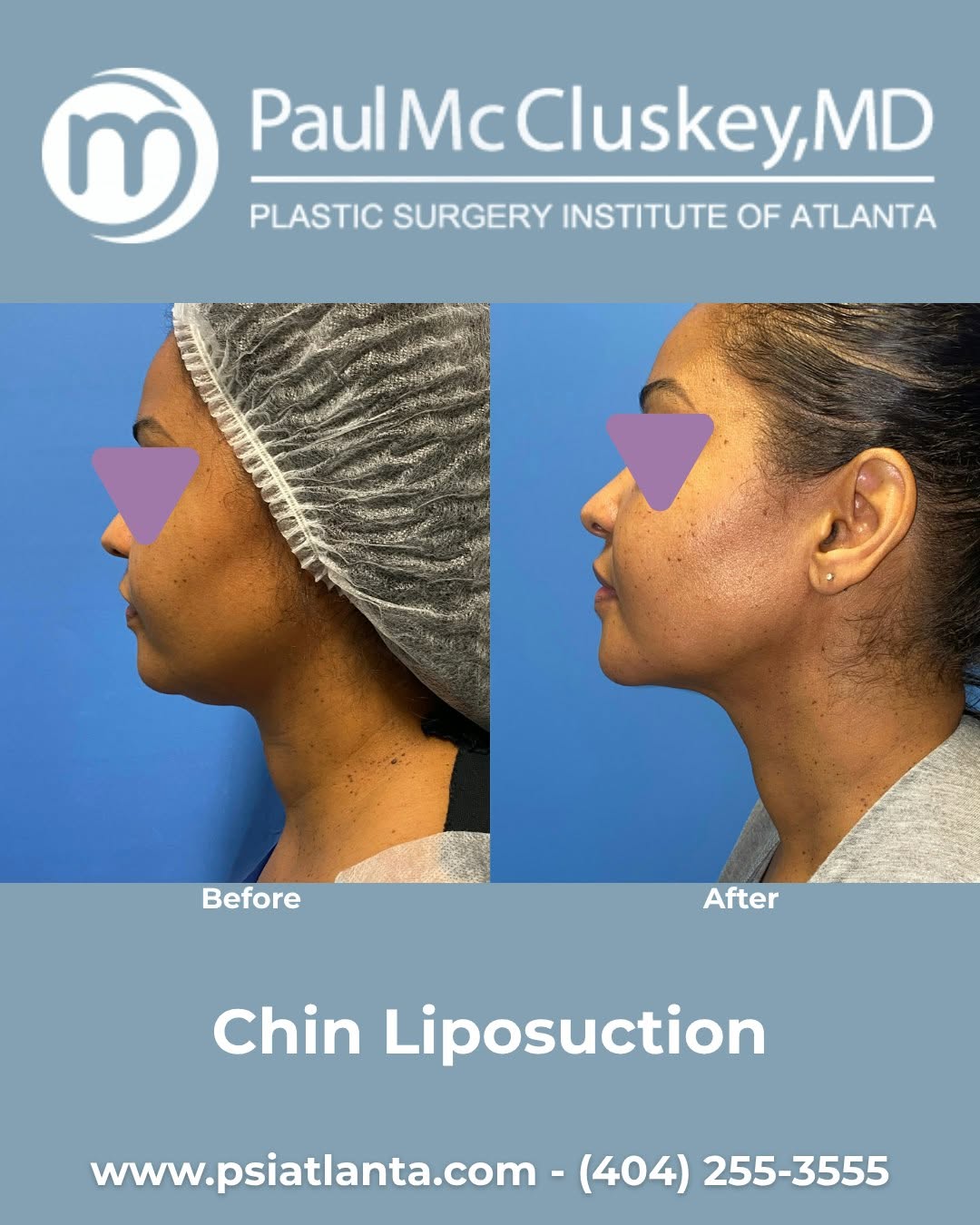 Instagram post by Dr. Paul McCluskey: Snatched from every angle ✨ Chin lipo can help define the jawline, reduce fullness beneath the chin, and bring more balance to your profile.…