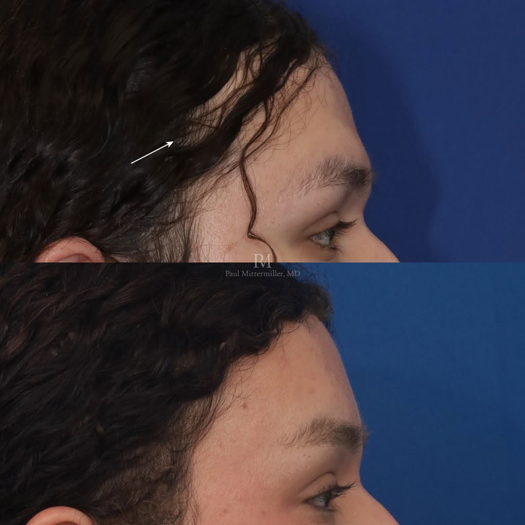 Instagram post by Dr. Paul Mittermiller: Surgical hairline lowering and hairline reshaping for facial feminization. This patient underwent a hairline lowering to improve the forehea…
