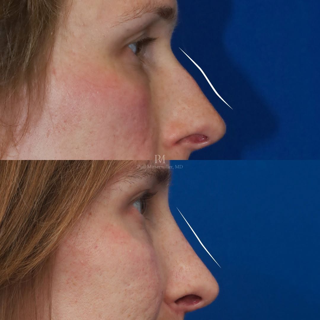 Instagram post by Dr. Paul Mittermiller: Feminizing rhinoplasty as part of facial feminization surgery. There were multiple goals for this operation. They included straightening the…