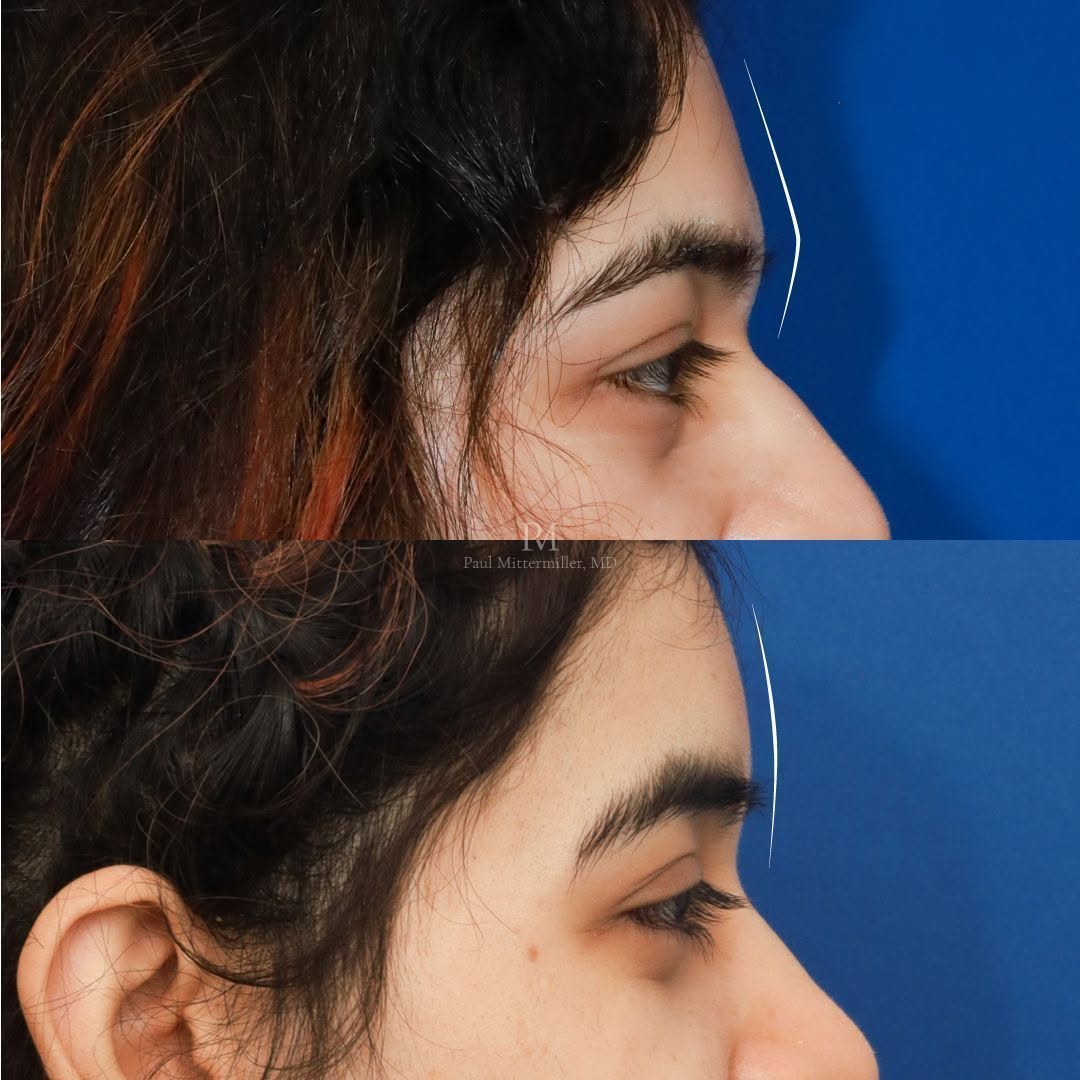 Instagram post by Dr. Paul Mittermiller: Type 3 brow bone reduction for facial feminization. A brow bone reduction reduces the brow prominence over the eyes. A masculine brow has a …