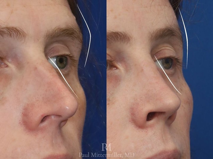 Instagram post by Dr. Paul Mittermiller: Feminizing rhinoplasty and orbital contouring as part of facial feminization surgery. This patient underwent multiple procedures as part of …