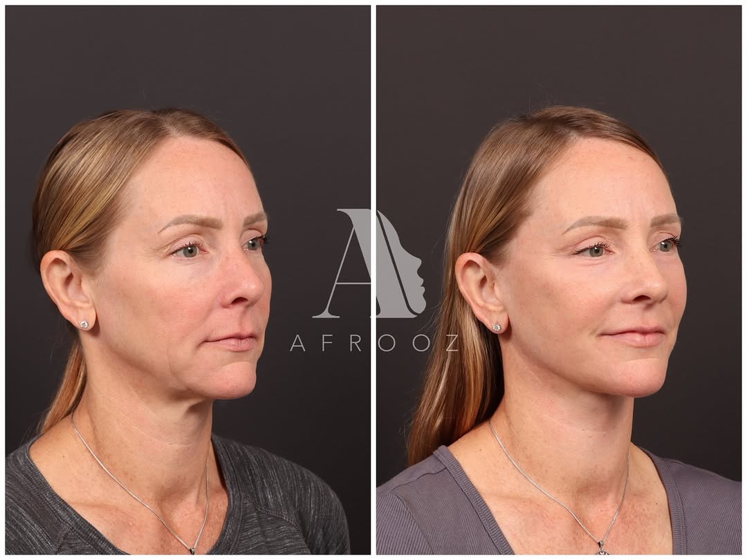 Instagram post by Dr. Paul N. Afrooz: 👉🏻 We previously shared Shannon’s result at 6 weeks post-op. These updated photos were taken at the 2-month mark. The changes are subtle, …