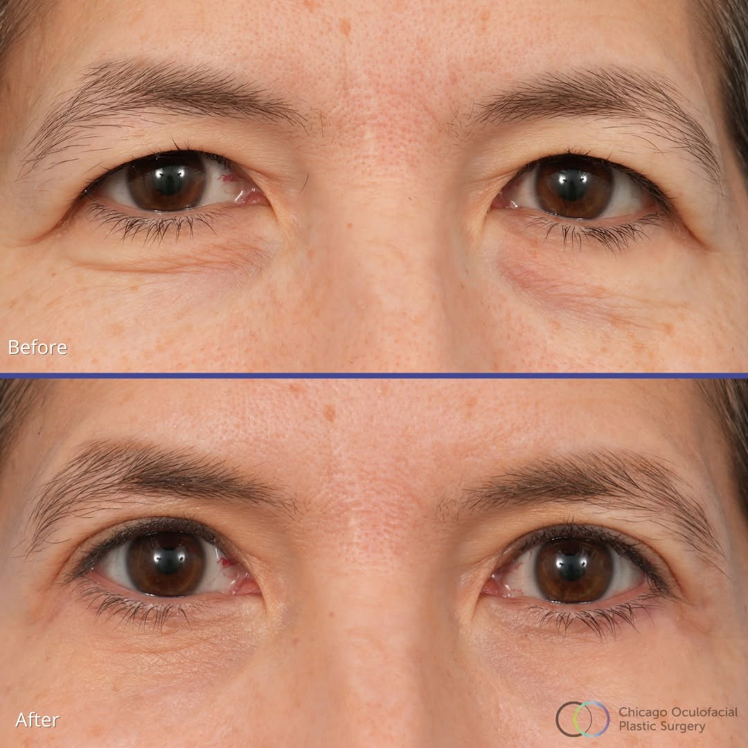 Instagram post by Dr. Paul Phelps: What a transformation, just five months after surgery! Our 57-year-old patient looks brighter, younger, and more refreshed after her quad bl…