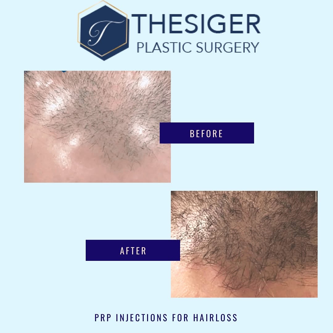 Instagram post by Dr. Paul S. Thesiger: Did you know that Thesiger Plastic Surgery offers hair restoration?! 🤩 Restore your hair's volume this year with the help of Dr. Thesiger a…