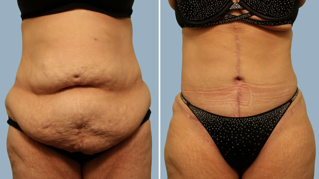 Instagram post by Dr. Paul Sabini: Transformation Tuesday...Considering body contouring after weight loss? A fleur-de-lis abdominoplasty may be the best option for patients wi…