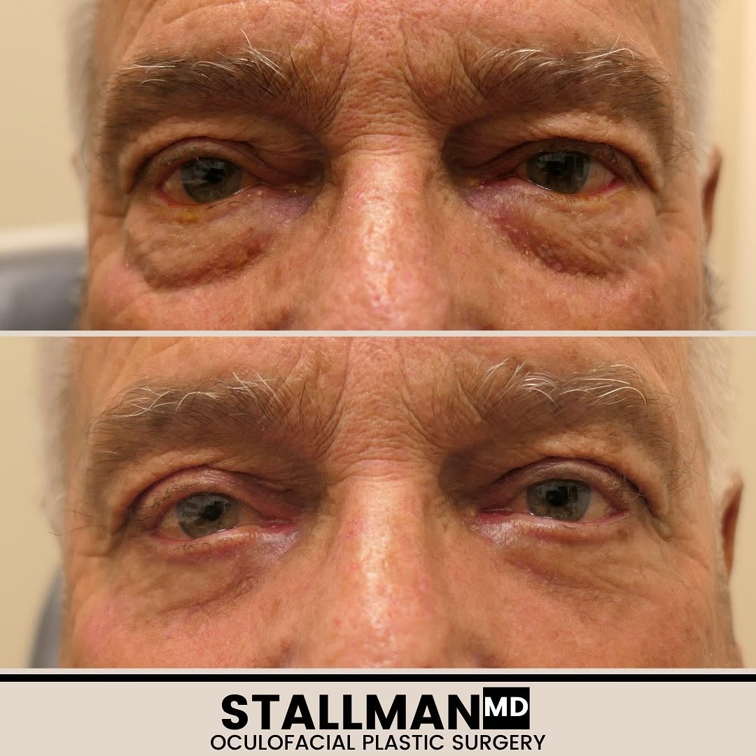 Instagram post by Dr. Paul T. Stallman: This nice man was concerned with heavy appearing, shadowed eyes but didn’t want to look too “different “. I performed upper and lower lid bl…