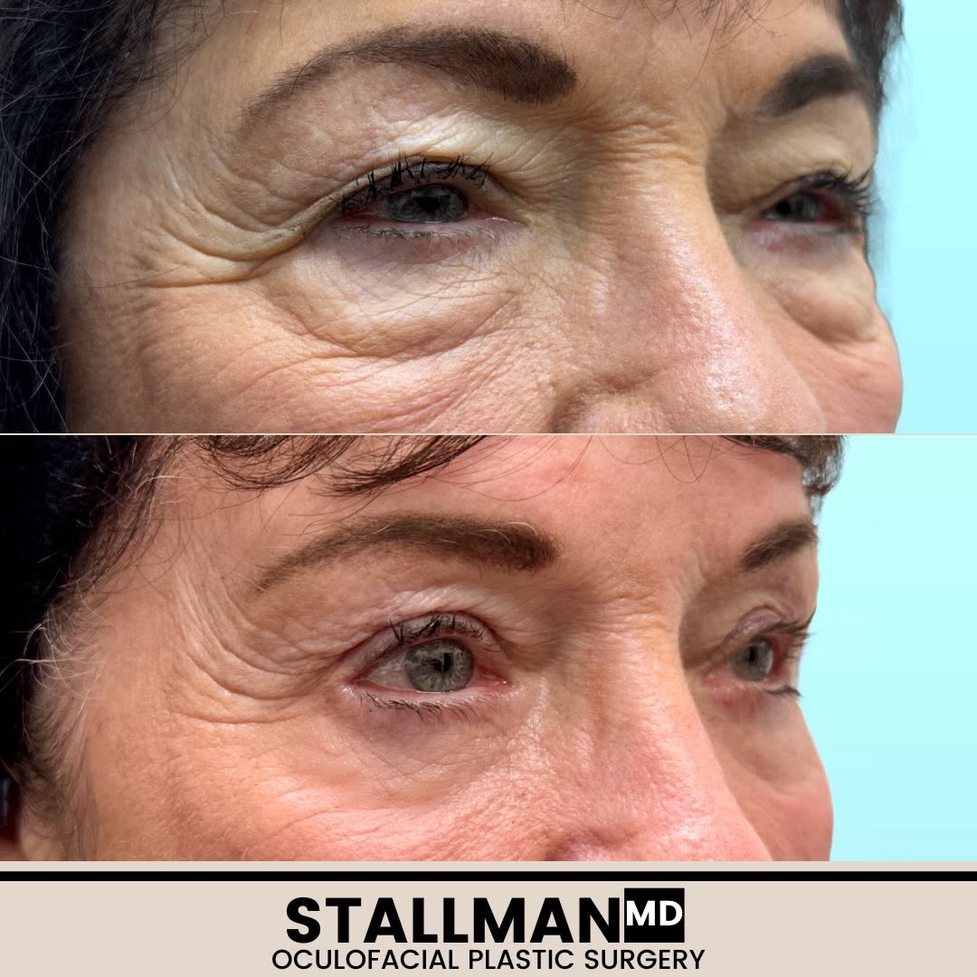 Instagram post by Dr. Paul T. Stallman: Hidden incision endoscopic brow contouring combined with blepharoplasty creates a natural yet significant enhancement. #endoscopicbrowlift #…