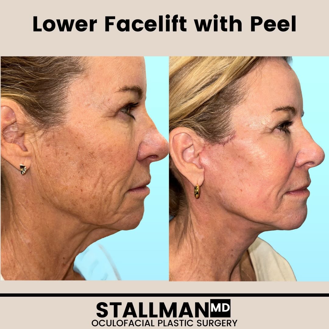 Instagram post by Dr. Paul T. Stallman: Key to lower facelift is for it to be natural!! Happy to see this result, just a few weeks out. #facelifts #oculofacialplasticsurgeon #facia…
