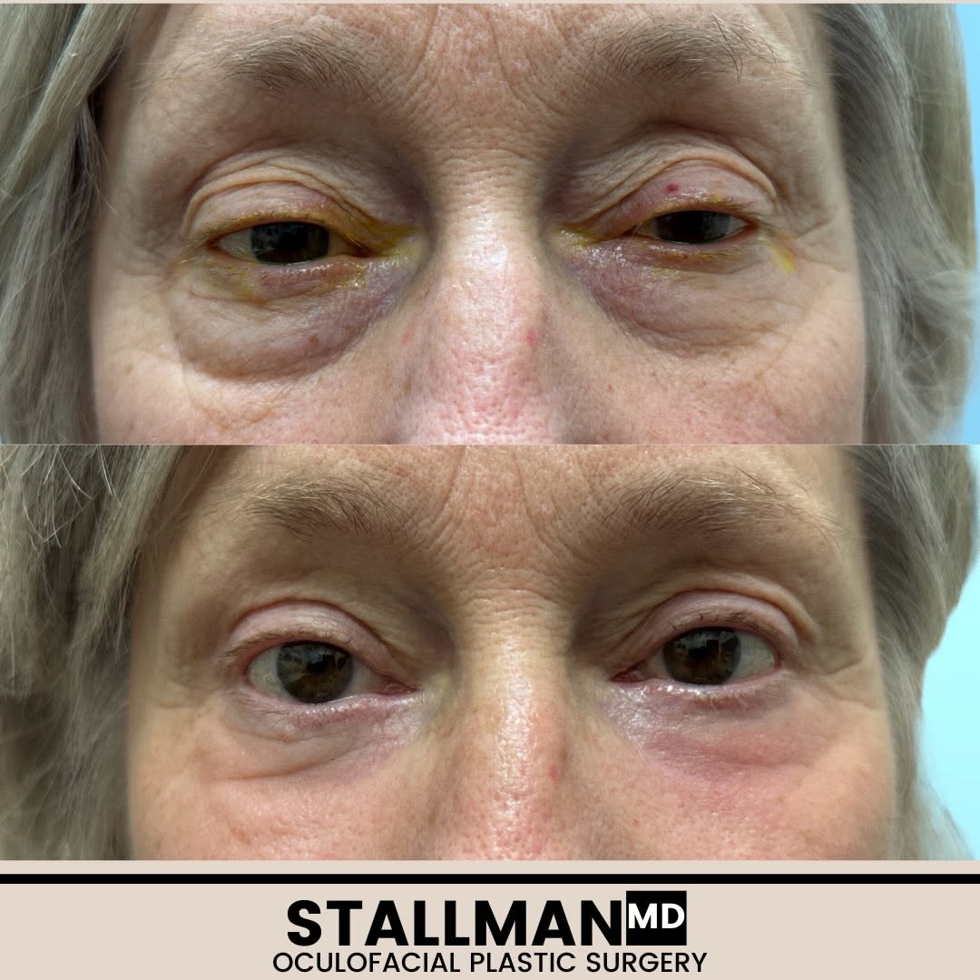 Instagram post by Dr. Paul T. Stallman: This person underwent a procedure to tighten a muscle in the upper lids(ptosis surgery) to relieve the mechanical droop of the lids. She als…