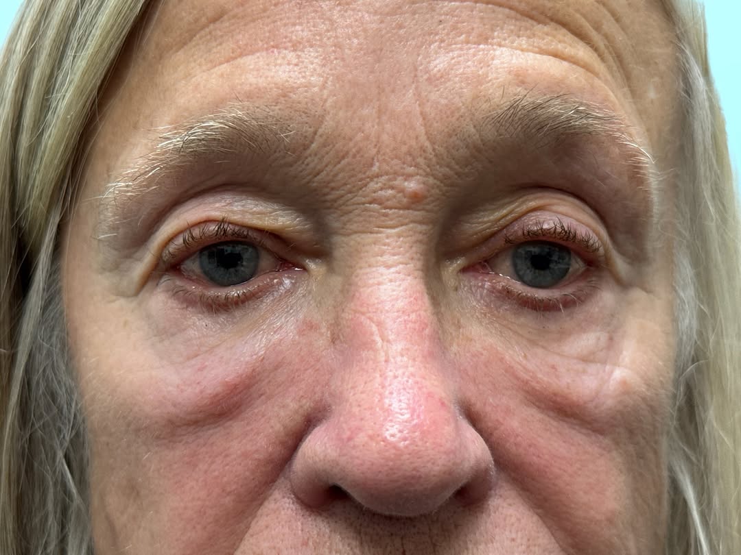 Instagram post by Dr. Paul T. Stallman: This patient was treated for under eye bags but these were not typical “eye bags”. The more typical under eye bulges sit higher and are the …
