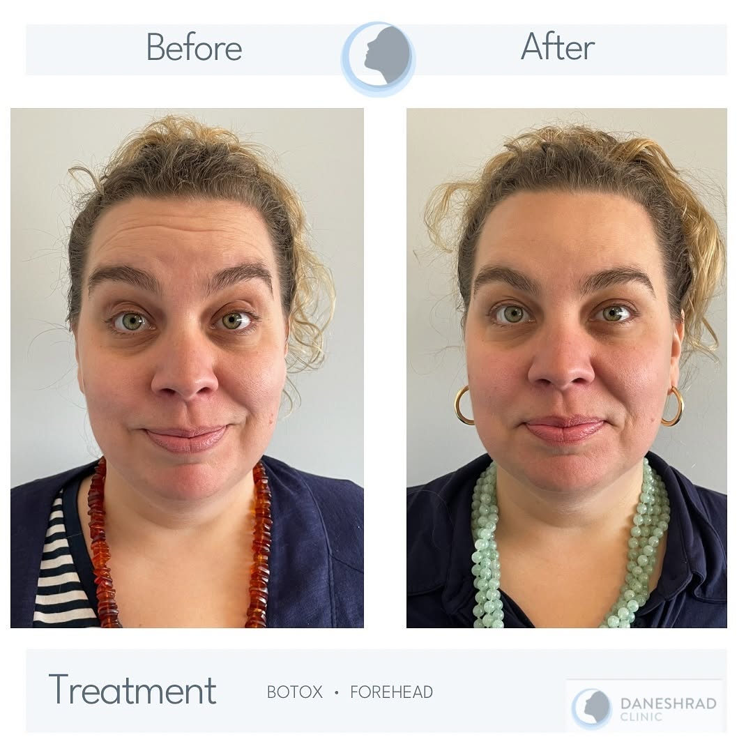 Instagram post by Dr. Payam Daneshrad: BOTOX Prevention is key. If you can’t make the deep wrinkle, you won’t have the deep wrinkle. Book your complimentary consultation with our …